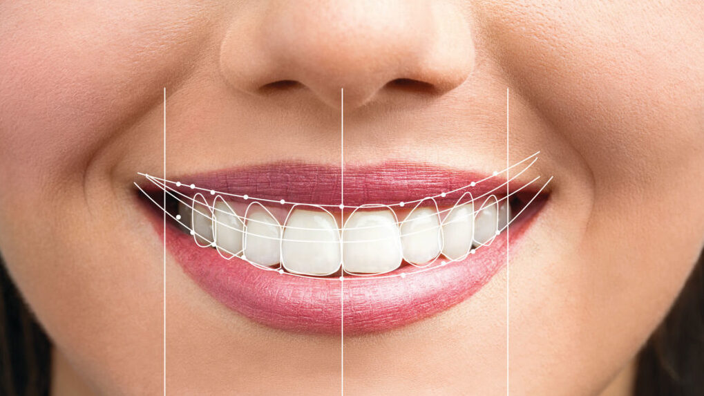 Perfect smile created with a smile makeover