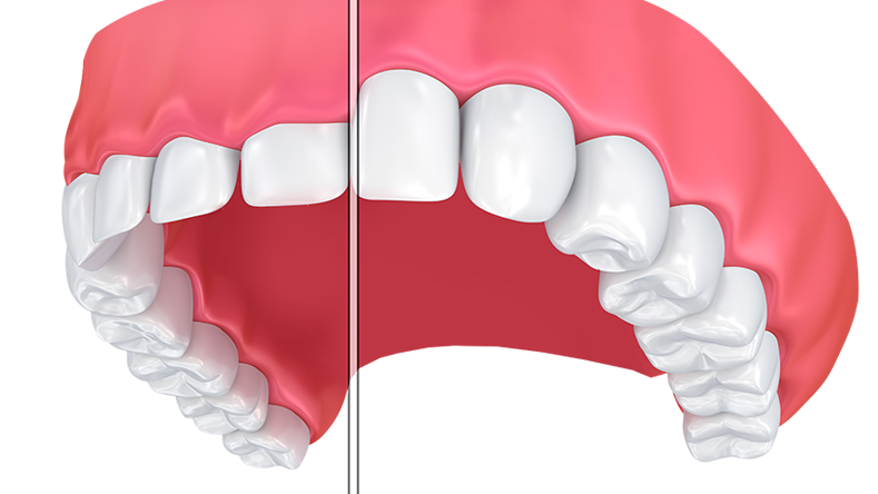 cosmetic gum contouring